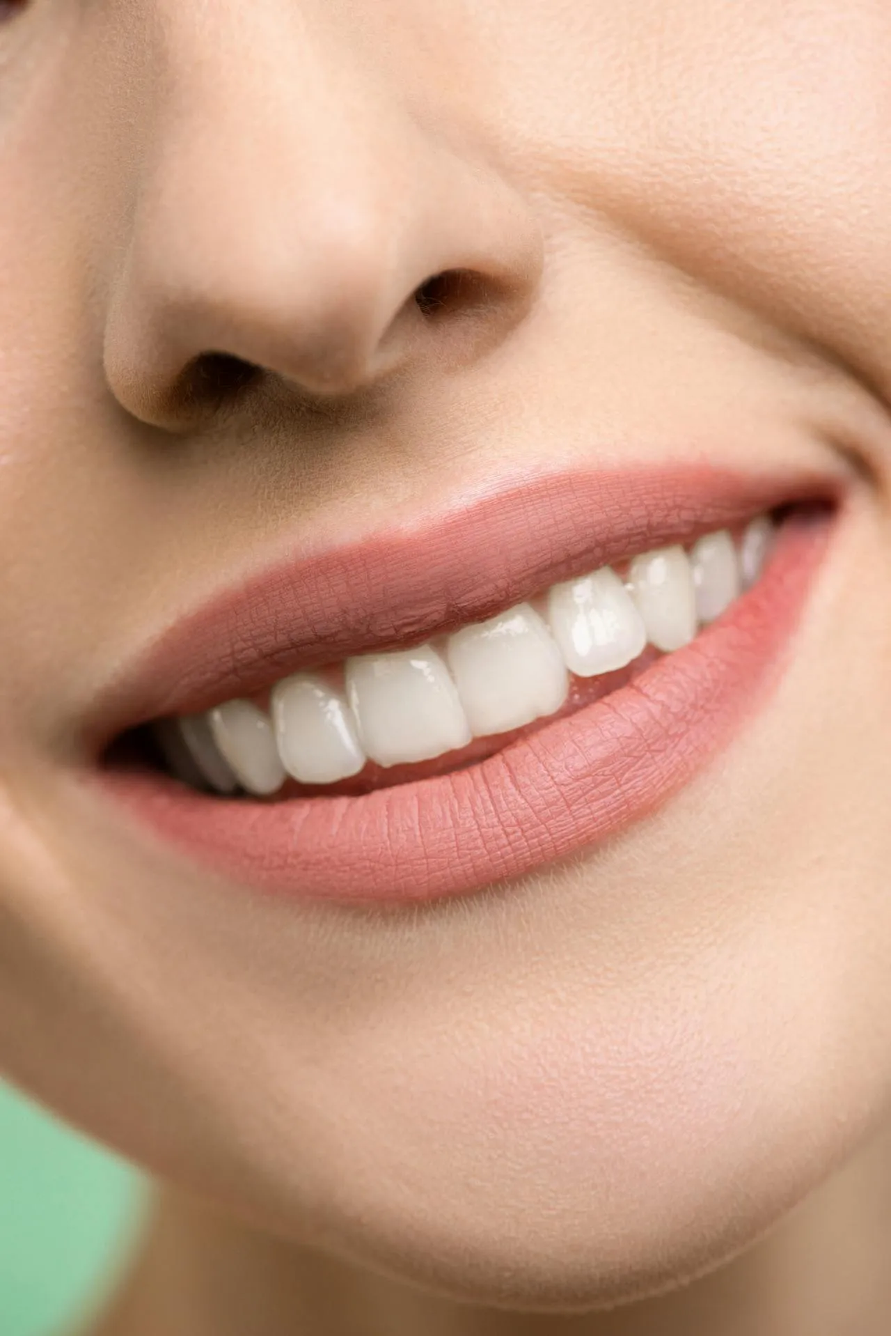 Beautiful smile result after a full smile makeover with E-max porcelain veneers in Turkey